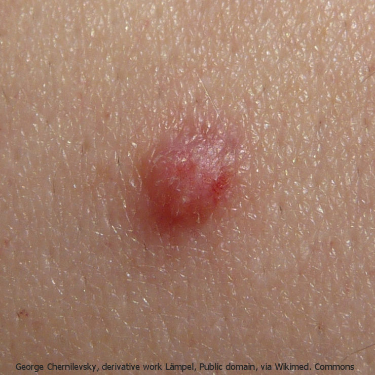 HPV-Impfung: aktuelle Empfehlungen 2023